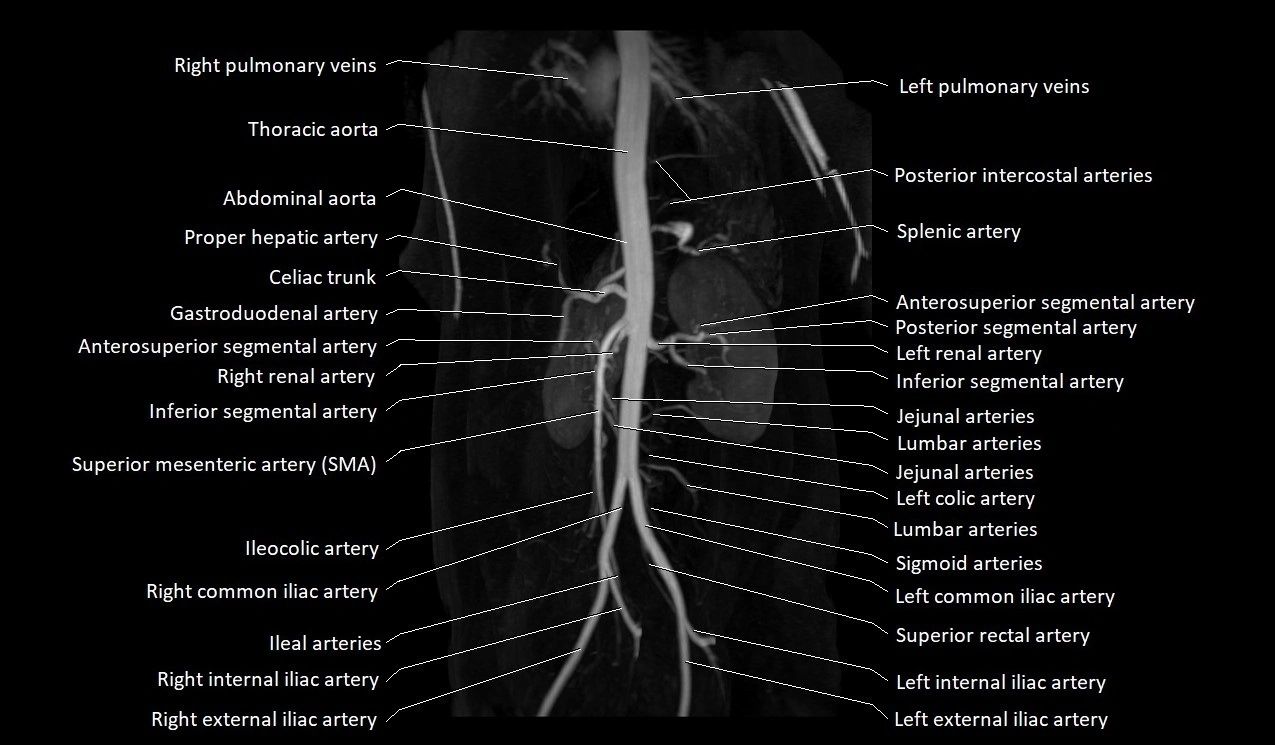 MRA abdomen (renal and mesenteric) angiography MIP 3D anatomy image 4.webp